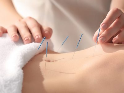 Acupuntura